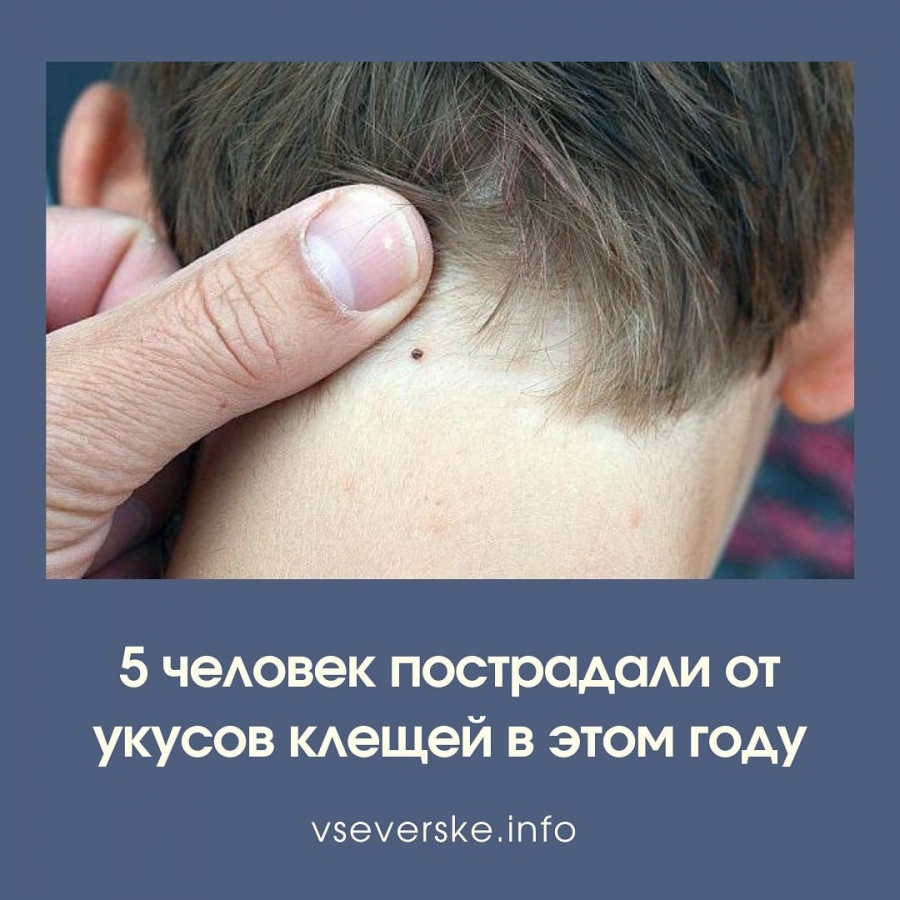 5 человек пострадали от укусов клещей в этом году 5 человек пострадали от укусов клещей в этом году